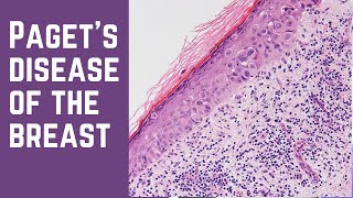 Pagets Disease of the Breast  Pathology mini tutorial [upl. by Worrad]