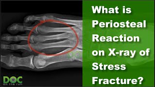 What is Periosteal Reaction on X ray of Stress Fracture [upl. by Delaine43]