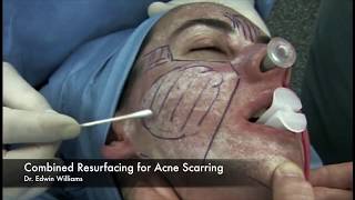 Laser amp Dermabrasion Treatment for Acne Scarring by Dr Edwin Williams [upl. by Codel]