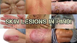 Skin Lesions in Hindi  Types of Skin lesions  Skin eruption in Hindi  Tarang Academy [upl. by Suicul940]