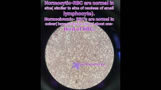 HematologyRBClymphocyte anaemia pathologymedical [upl. by Janis]