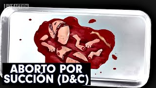 Aborto del 1er Trimestre  Dilatación y Legrado por Succión DampC [upl. by Tyre]