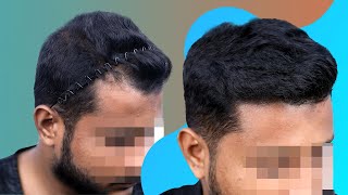 Bangladesh Hair Transplants Deliver Receding Hairline Solved in Just 7 Months [upl. by Noirda114]