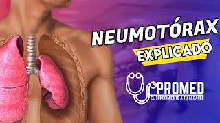 😨NEUMOTÓRAX 👉 Definición Clasificación fisiopatología [upl. by Wonacott]