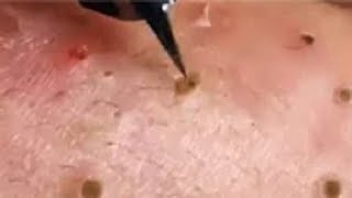 Full Giant Blackheads Popping Video Blackheads Removal 2019 [upl. by Milson322]