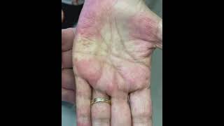 Palmar erythema [upl. by Ahsiekal]