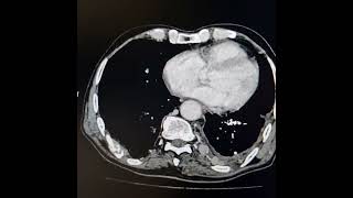 Adenocarcinoma of left lung with extrathoracic and intraspinal extension [upl. by Cacilie]