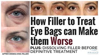 How Under Eye Fillers can Make Prominent Eye Bags Worse and Safely Dissolving Filler [upl. by Meesaw640]