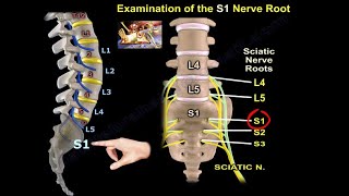 Examination Of S1 Nerve Root  Everything You Need To Know  Dr Nabil Ebraheim [upl. by Swart429]