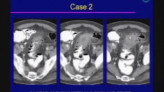 Acute Abdomen Imaging Emergency Radiology [upl. by Nadnarb57]