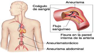 Causas de aneurisma [upl. by Tuck]