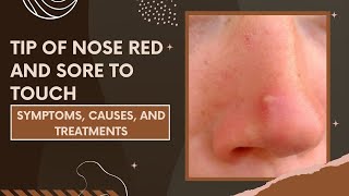 Tip of Nose Red and Sore to Touch  Symptoms Causes and Treatments [upl. by Yecats210]