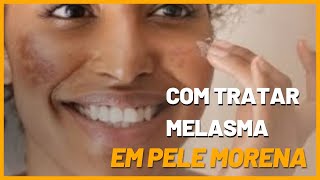 TRATAMENTO DE MELASMA EM PELE MORENA [upl. by Horan]