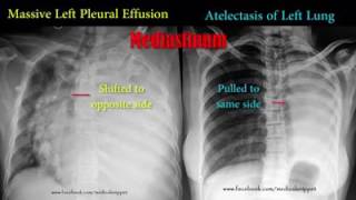 Ventricular Bigeminy [upl. by Pressman]