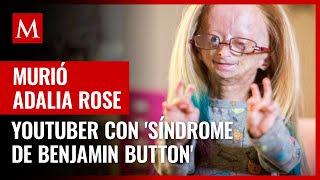 Murió Adalia Rose youtuber con el síndrome de Benjamin Button a los 15 años [upl. by Kerat214]