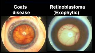 Differentiating Coats Disease from Retinoblastoma [upl. by Berkshire564]