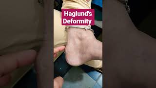 Haglunds Deformity Retro Calcaneal SpurDr Sai Chandra [upl. by Neelehtak701]