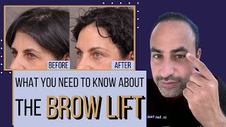 What You Need To Know About The Brow Lift  Dr Ben Talei Beverly Hills Los Angeles [upl. by Lekcim]