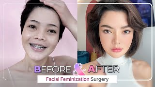 SUB Check out our Amazing Before and After FACIAL FEMINIZATION SURGERY FFS Top 5 [upl. by Eneles]