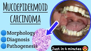 Mucoepidermoid CarcinomaWhat causes Mucoepidermoid carcinomapathology medico [upl. by Yrrep834]