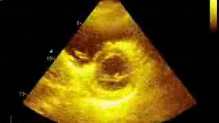 Pulmonary embolism echocardiography [upl. by Notlih562]