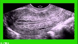 GYN Ultrasound [upl. by Cherianne]