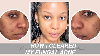 How I Cleared My Fungal Acne [upl. by Whitcher]