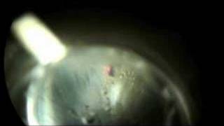 Laser Peripheral Iriditotomy to Prevent Glaucoma Part 2 [upl. by Oribella]