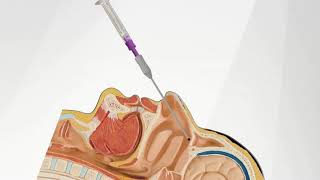 The SphenoCath® Procedure [upl. by Notlem]