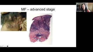 Pathology Grand Rounds  Cutaneous TCell Lymphoma  Dr Michi Shinohara [upl. by Enicar518]