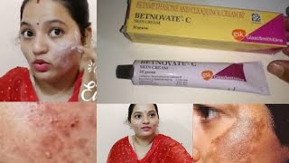 Betnovate C skin cream review Is it safe to use Betnovate dark spots remove skin glowing in Telugu [upl. by Ianahs473]