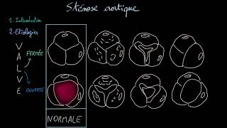 Sténose aortique  Docteur Synapse [upl. by Emersen]