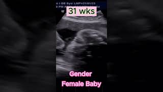 Baby Gender GIRL  at 31wks and 35wks Pregnancy ultrasound pregnancy babygirl gender Baby [upl. by Moll]