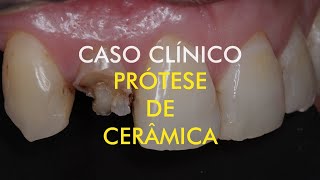 Prótese Unitária Dente Anterior Cerâmica • Dr Luis Drummond • Odontologia • Clínica Drummond [upl. by Rollie]