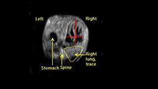 Normal Fetal Thoracic Anatomy and Common Malformations [upl. by Luapnaes]