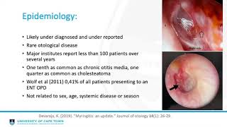 Granular myringitis Matthew White [upl. by Diena698]