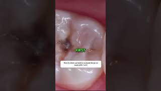 how to clean up severe occlusal decay on tooth  How Teeth Are Professionally Deep Cleaned dental [upl. by Groot16]