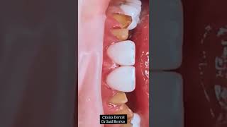 fundas de EMAX disilicato de litio dientes [upl. by Eek854]