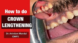 How to do Crown Lengthening l Dr Arindam Mandaloralsurgery [upl. by Nikos910]