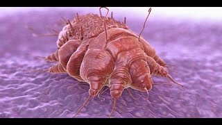 ☢☢Where Do Scabies Come From How To Kill Scabies Mites On Bedding Get Rid Of Scabies [upl. by Ardnaiek]