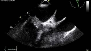 ENORMOUS MITRAL VEGETATION WITH SEVERE MR [upl. by Leach]