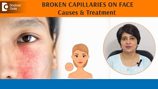 BROKEN CAPILLARIES on FACE Skin REDNESS  BLOOD VESSELS on face  DrRasya Dixit  Doctors Circle [upl. by Suzy]