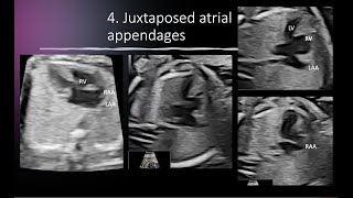 Fetal Situs inversus totalis levocardia JUXTAPOSED atrial appendages ccTGA and more [upl. by Ecnerwal]