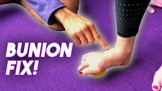 HOW TO FIX A BUNION  Episode 1 [upl. by Pegma129]