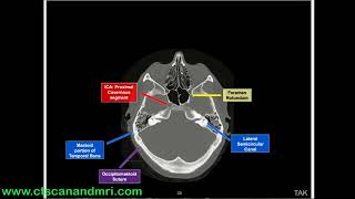 CT bone window study [upl. by Vanda]