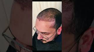 Front Cosmatic hairline fue Hairtransplant after one week [upl. by Konstanze]