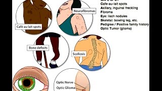 Neurofibromatosis Type 1 NF1 Mnemonic for Licensing Exams [upl. by Ahsiuqal]