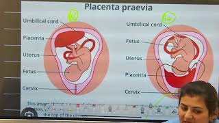 HIGH RISK NEWBORN PRETERM AND POST TERM BABY NCLEX [upl. by Hnim]