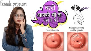 What is Nabothian cysts   Causes  Symptoms  Treatment  By Dr Vanshika saxena [upl. by Hillier]