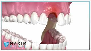 Bottransplantatie  Maxim Clinic [upl. by Alaham]